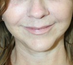 Face Lift