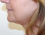Face Lift