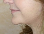 Face Lift