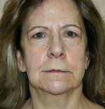 Face Lift
