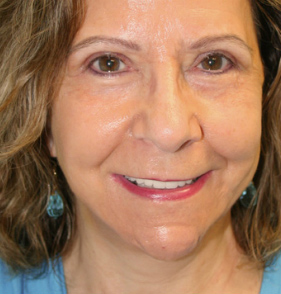 Face Lift