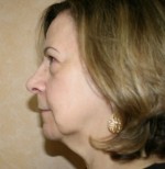 Face Lift