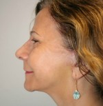 Face Lift