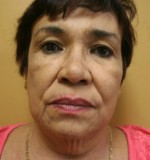 Face Lift