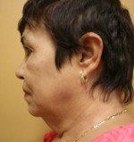 Face Lift
