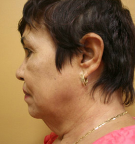 Face Lift