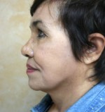 Face Lift
