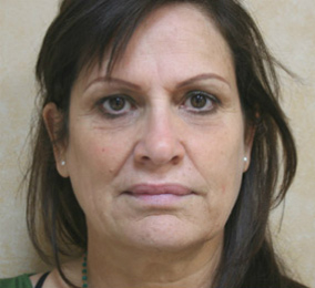 Face Lift
