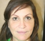 Face Lift