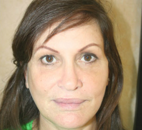 Face Lift