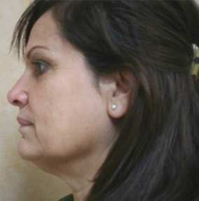 Face Lift