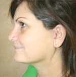 Face Lift