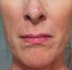 Face Lift