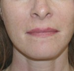 Face Lift