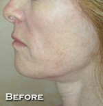 Face Lift