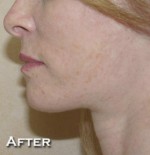 Face Lift