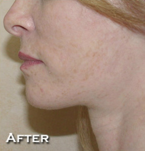 Face Lift
