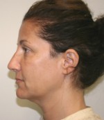 Face Lift