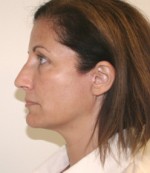 Face Lift