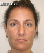 Face Lift