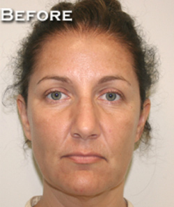Face Lift