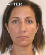 Face Lift