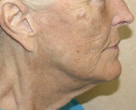 Face Lift