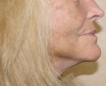 Face Lift