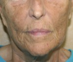 Face Lift