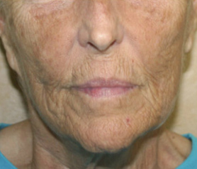Face Lift