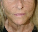 Face Lift