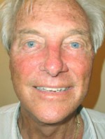 Face Lift