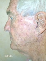 Face Lift