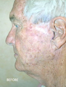 Face Lift