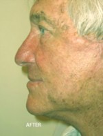 Face Lift