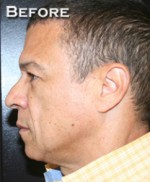 Face Lift