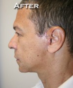 Face Lift