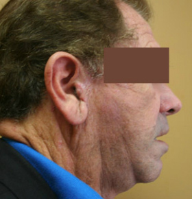 Face Lift