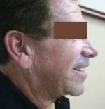 Face Lift