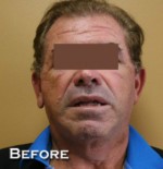 Face Lift