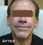 Face Lift