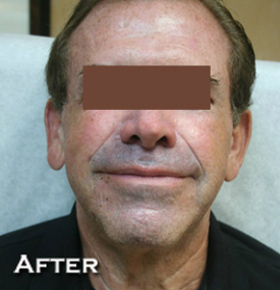 Face Lift