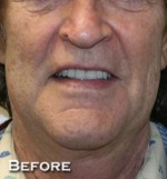 Face Lift