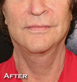 Face Lift