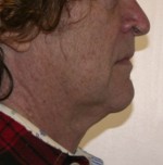 Face Lift