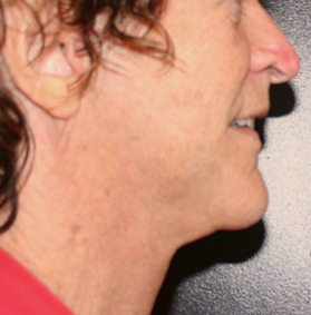 Face Lift