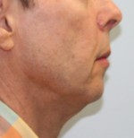 Face Lift