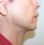 Face Lift