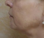 Face Lift