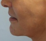 Face Lift